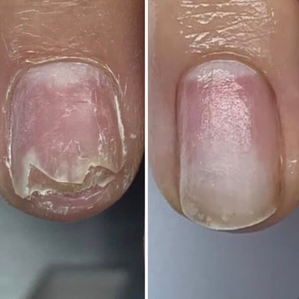 Регенеруючий лосьйон для нігтів Resultum Onistopix Lotion, 10 мл
