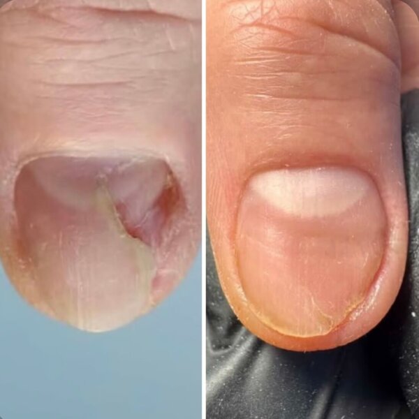 Регенеруючий лосьйон для нігтів Resultum Onistopix Lotion, 10 мл