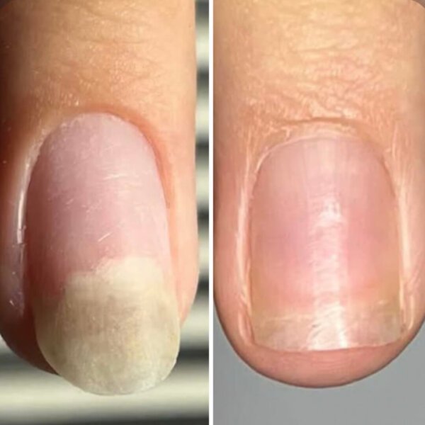 Олія проти оніхолізису та грибка Resultum Onistopix Oil, 8 мл