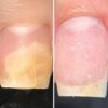 Олія проти оніхолізису та грибка Resultum Onistopix Oil, 8 мл
