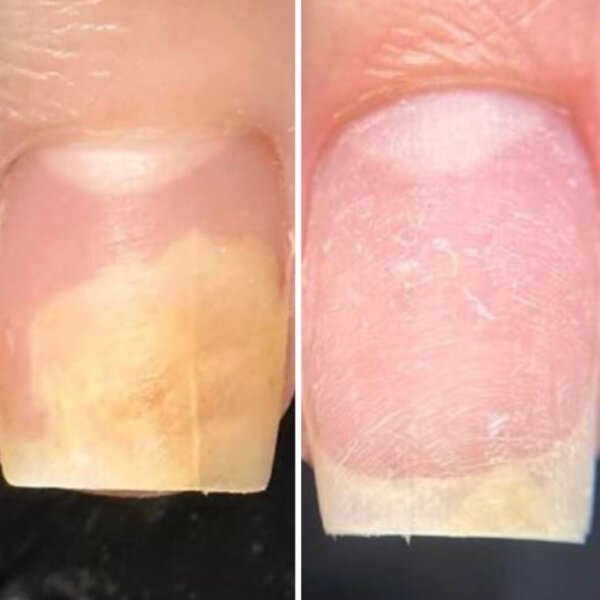 Олія проти оніхолізису та грибка Resultum Onistopix Oil, 8 мл