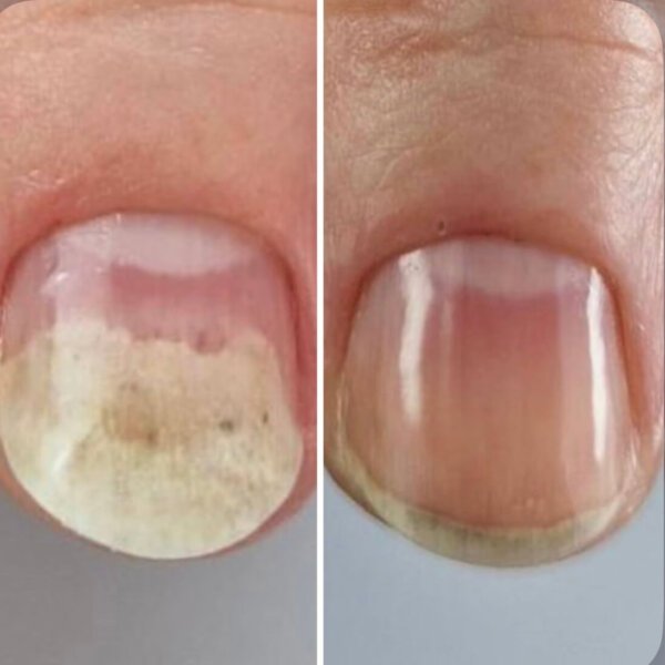 Олія проти оніхолізису та грибка Resultum Onistopix Oil, 8 мл